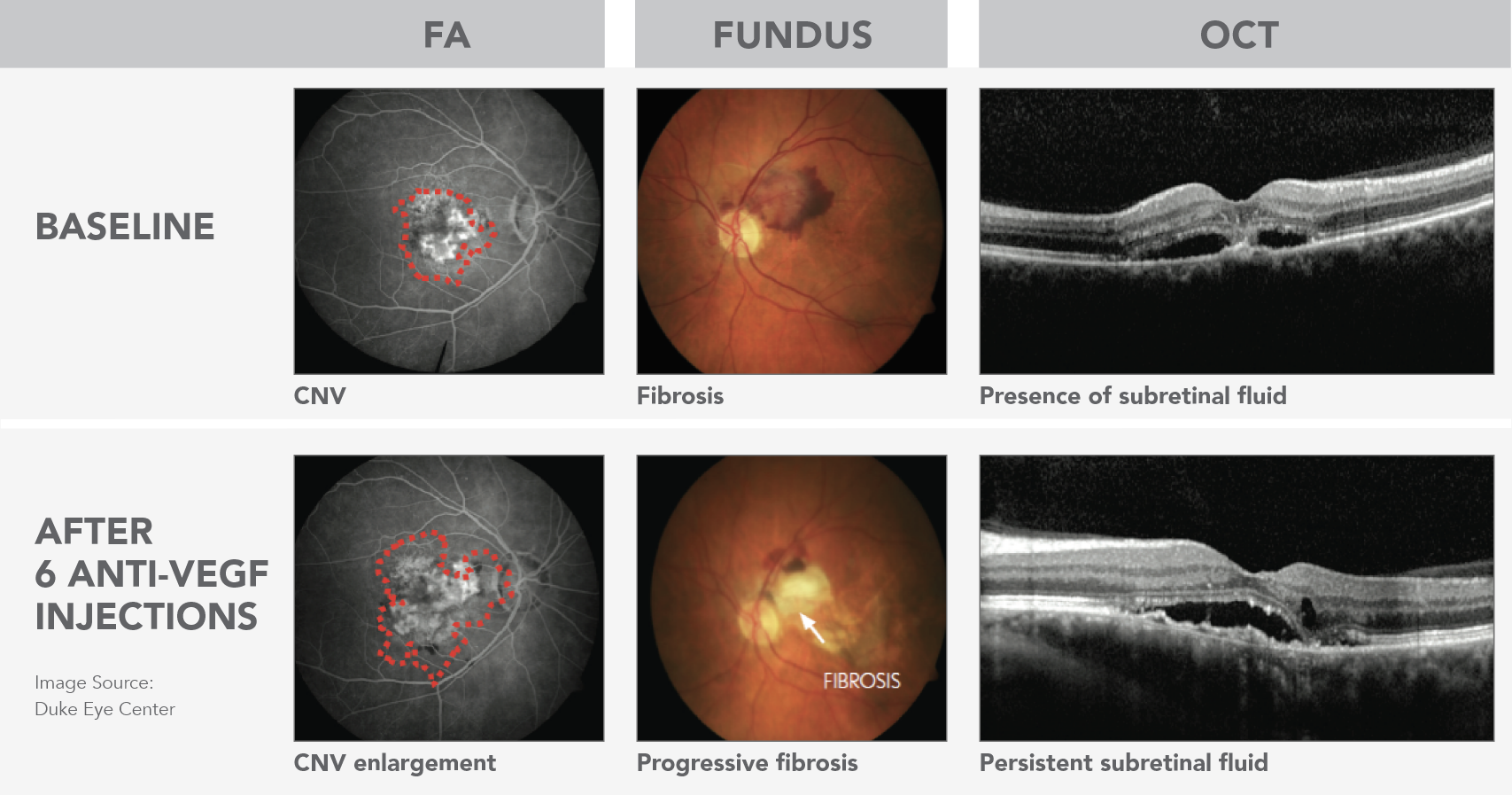 Persistent retinal fluid can be visualized using multiple imaging modalities