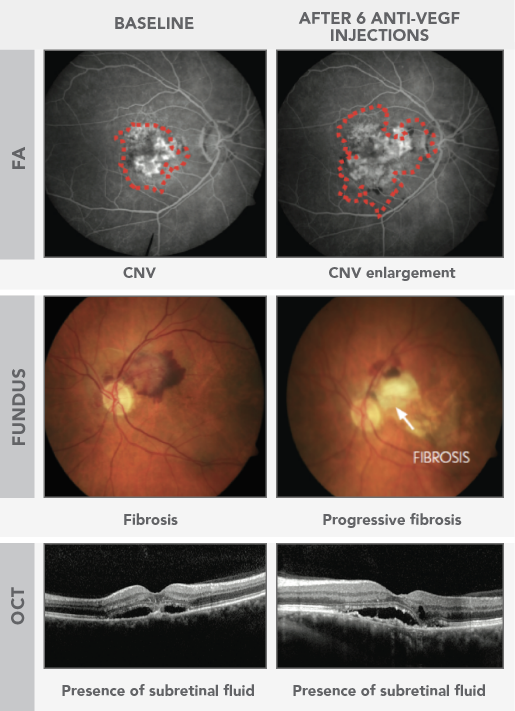 Persistent retinal fluid can be visualized using multiple imaging modalities